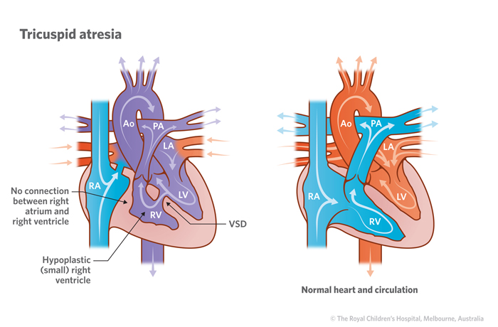 19a_Tricuspid_atresia 19a_Tricuspid_atresia