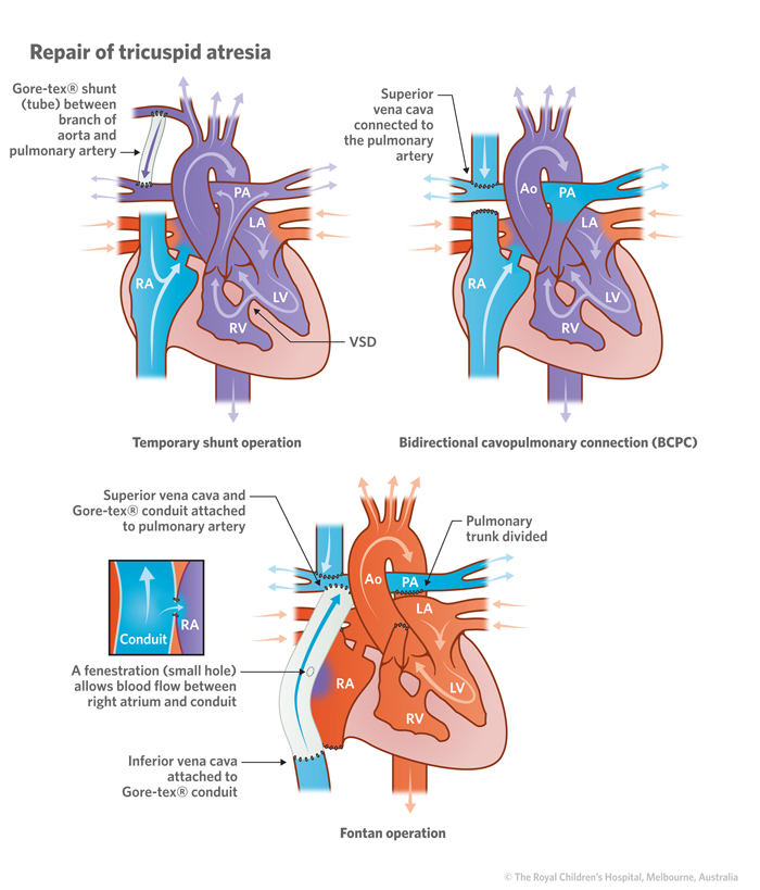 19b_Tricuspid_atresia 19b_Tricuspid_atresia