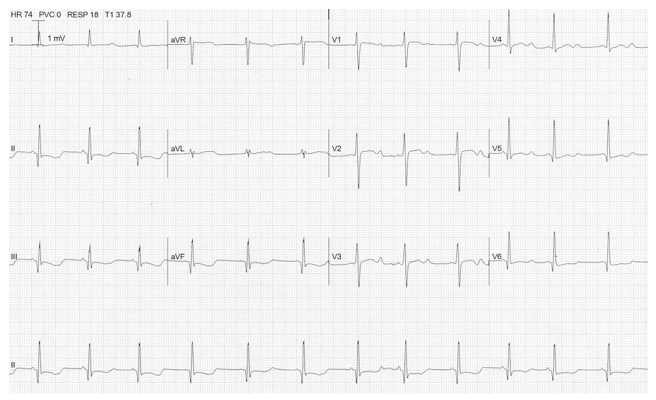 ECG-ST ECG-ST