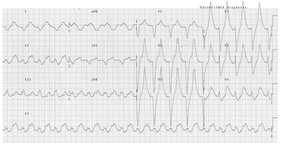 ECG: prolonged PR interval, broad bizarre QRS complexes, peaked T waves ECG: prolonged PR interval, broad bizarre QRS complexes, peaked T waves