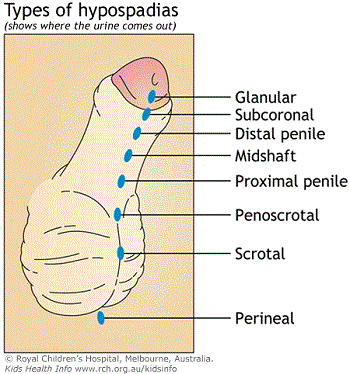 Hypospadias Hypospadias