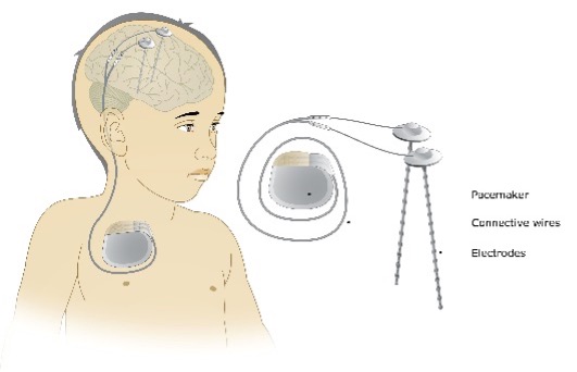 Deep brain stimulation device Deep brain stimulation device